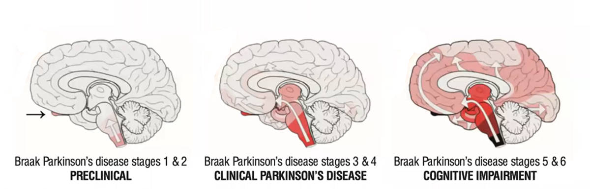 Parkinsons stages