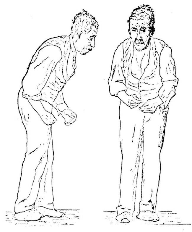 Parkinsons disease: Sir William Richard Gowers Parkinson Disease sketch 1886